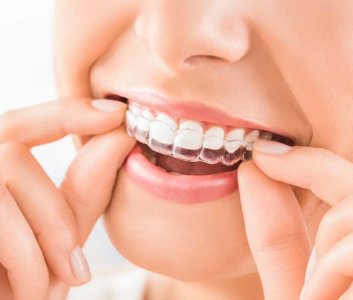 Allineatori trasparenti - Studio dentistico Azzolina Gozzi - Sorridi dalla prima infanzia alla terza età