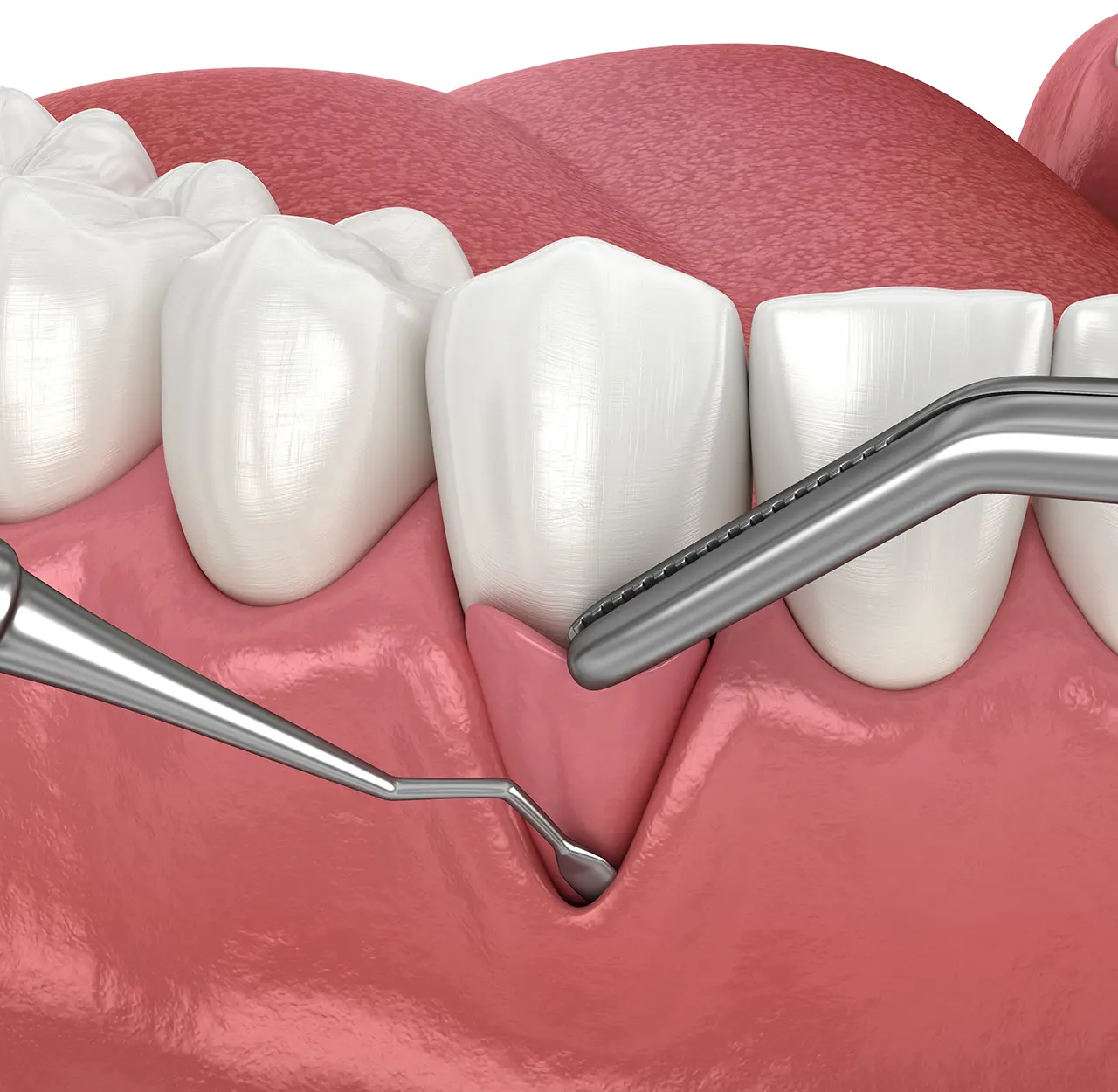 Chirurgia Parodontale - illustrazione - Studio dentistico Azzolina Gozzi - Sorridi dalla prima infanzia alla terza età