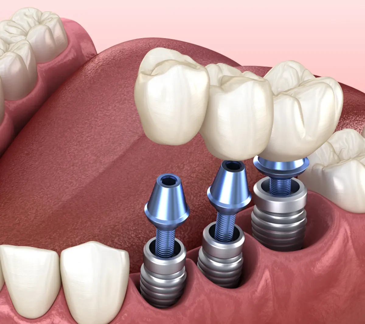 Impianti dentali - illustrazione - Studio dentistico Azzolina Gozzi - Sorridi dalla prima infanzia alla terza età