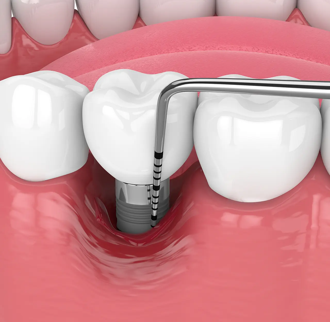 Implantologia dentale - illustrazione - Studio dentistico Azzolina Gozzi - Sorridi dalla prima infanzia alla terza età