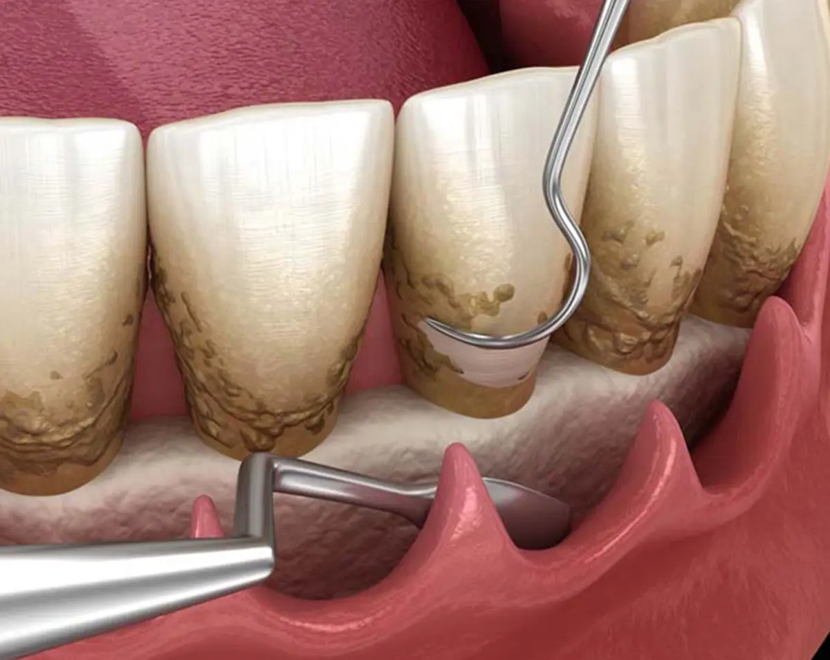 Trattamento malattia parodontale - illustrazione - Studio dentistico Azzolina Gozzi - Sorridi dalla prima infanzia alla terza età